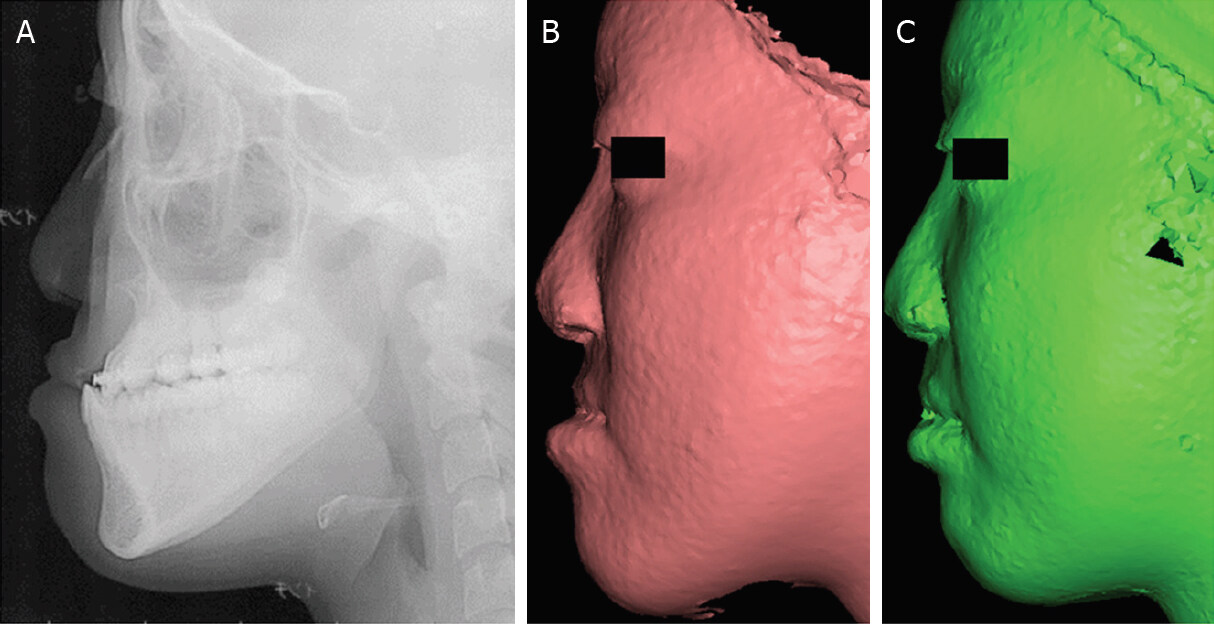 Facial morphospace: a clinical quantitative analysis of the three-dimensional face in patients with cleft lip and palate