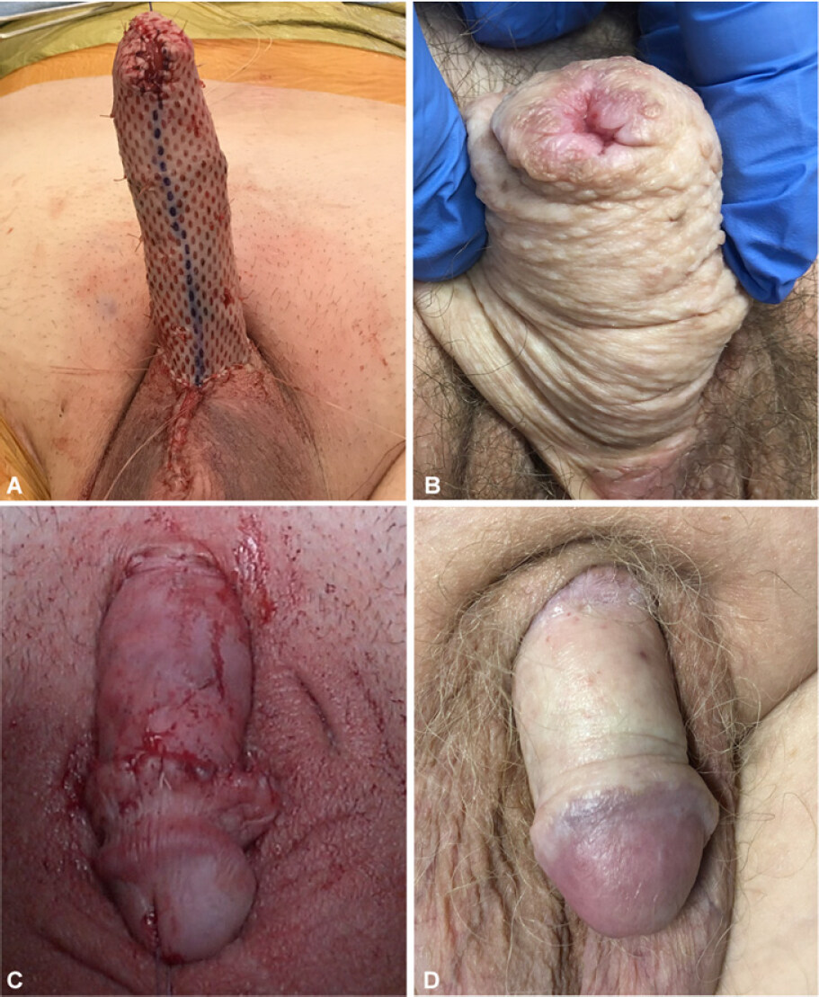 Skin grafting for penile skin loss