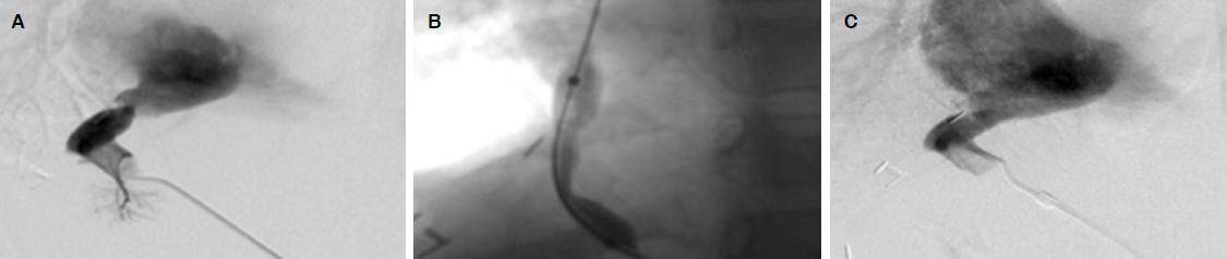 Interventional radiology for post-transplant anastomotic complications