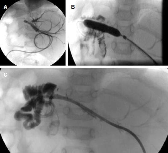 Interventional radiology for post-transplant anastomotic complications