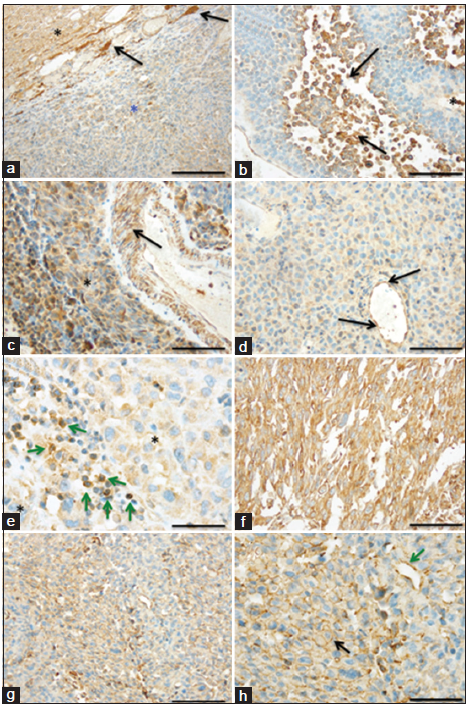 Tumor necrosis factor receptor superfamily member 9 is upregulated in the endothelium and tumor cells in melanoma brain metastasis