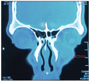 Lacrimal sac rhinosporidiosis