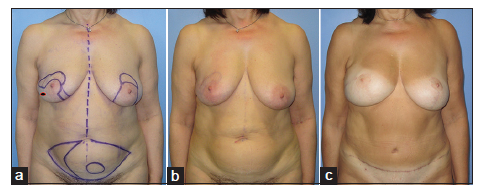 A novel approach to achieve breast symmetry in a single-stage procedure