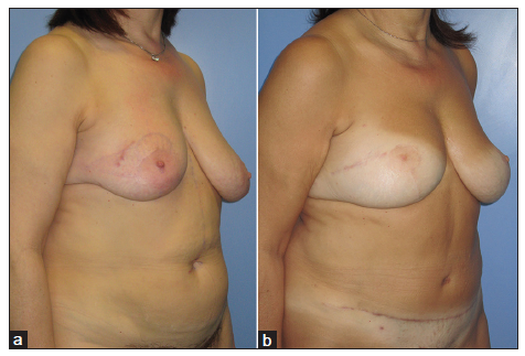 A novel approach to achieve breast symmetry in a single-stage procedure