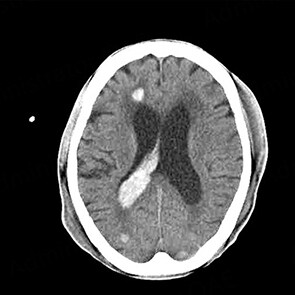 What to do with patients with active infective endocarditis complicated by intracranial bleeding