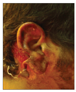 Primary repair of ear laceration with wedge resection