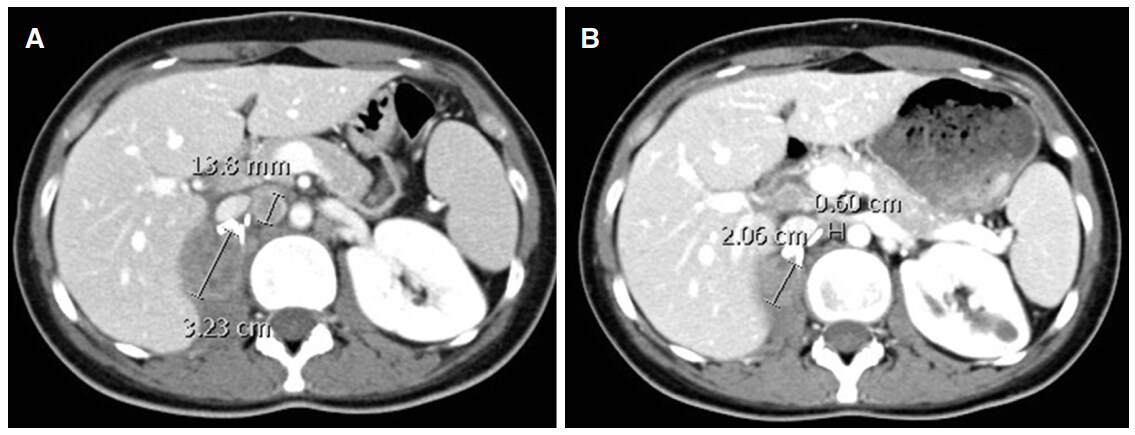 Metastatic renal medullary carcinoma: response to chemotherapy and unusual long survival