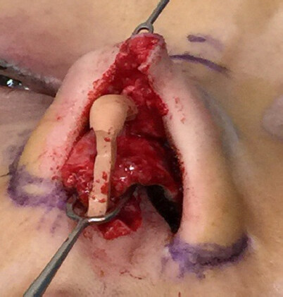 Costal cartilage graft in Asian rhinoplasty: surgical techniques