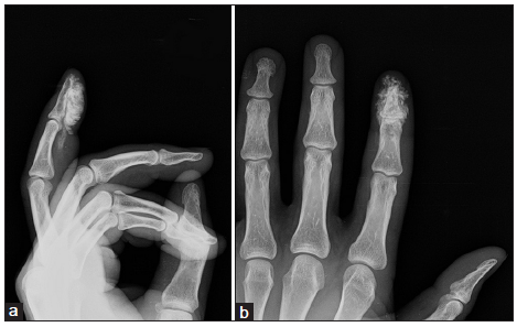 High pressure paint gun injury of the index finger: a case report