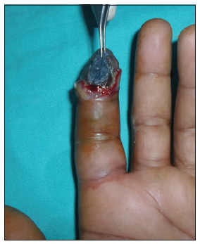 High pressure paint gun injury of the index finger: a case report