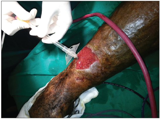Role of jet force technology in wound management