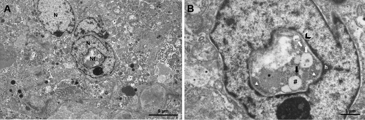 β-catenin in intranuclear inclusions of hepatocellular carcinoma