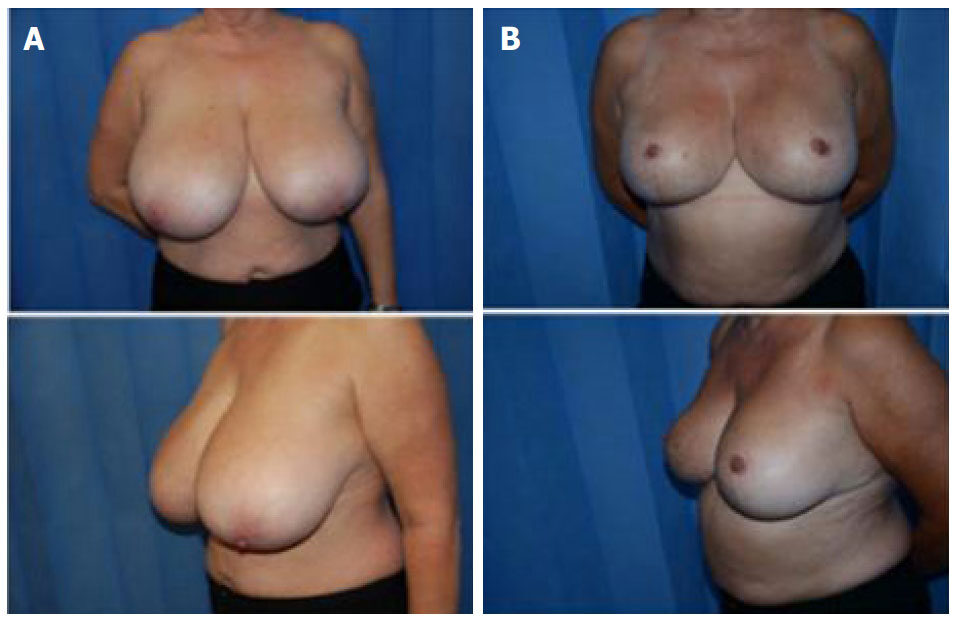 Technical refinements of the modified central mound breast reduction