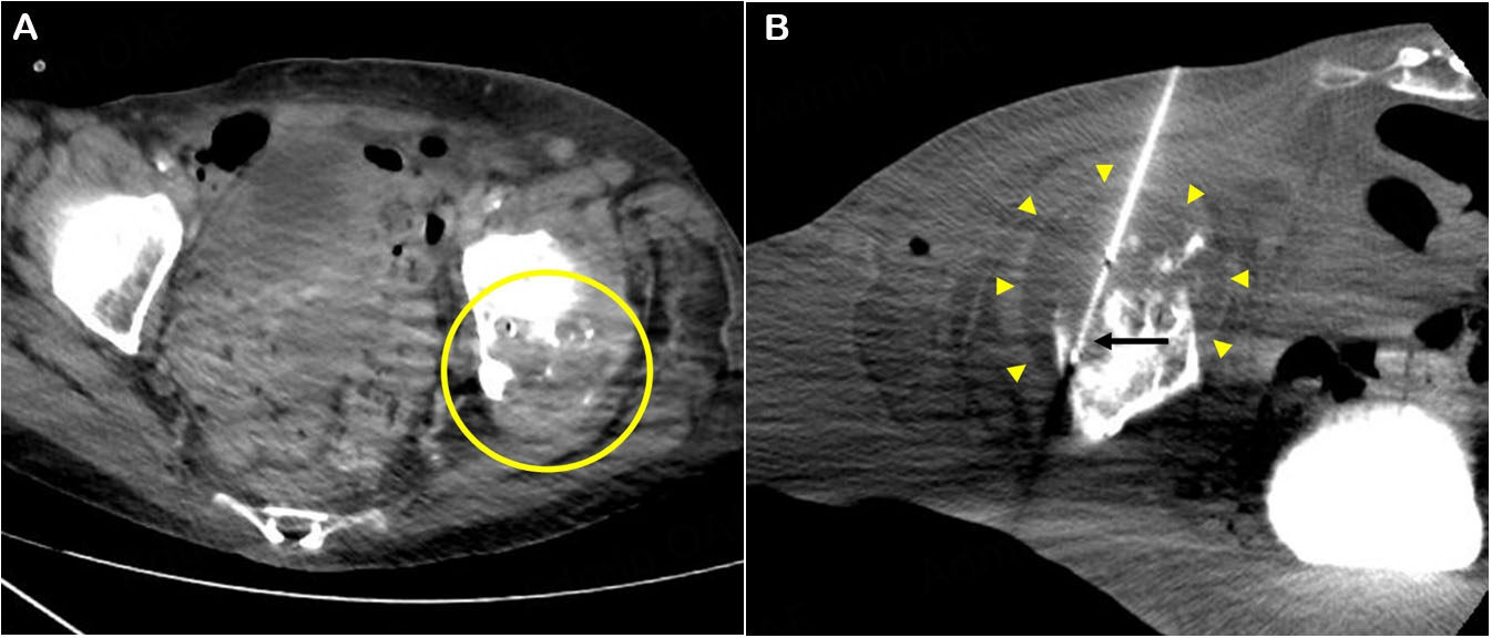 Thermal ablation of metastatic disease to the musculoskeletal system