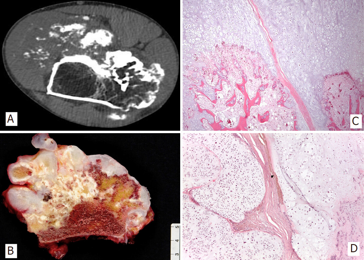 Primary malignant tumors of bone surface: a review with emphasis in differential diagnosis