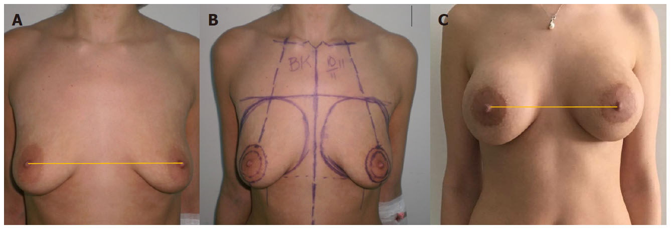 A simple classification and a simplified treatment's algorithm for ptotic breasts