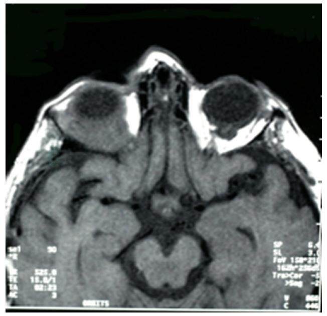 Metastatic breast cancer: an unusual cause of diplopia
