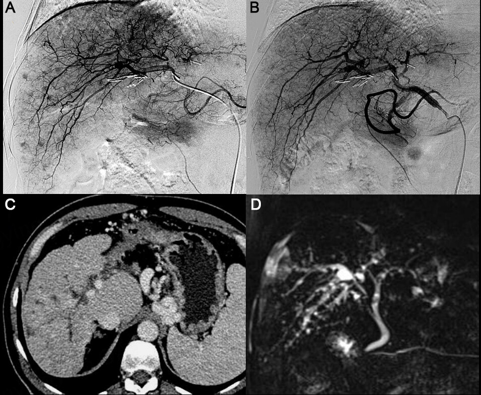 Chemoembolization with Degradable Starch Microspheres (DSM-TACE): expanding indications in HCC multidisciplinary tumor board