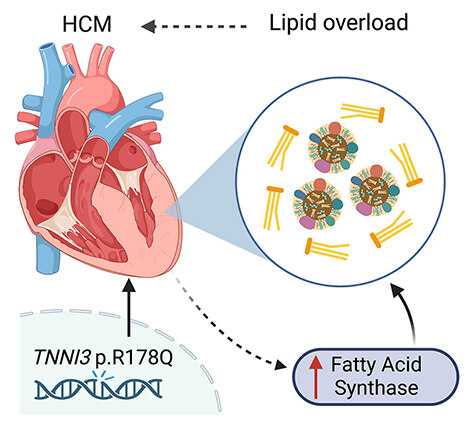 Lipid overload - a culprit for hypertrophic cardiomyopathy?