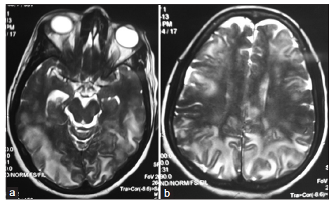 Posterior reversible encephalopathy syndrome due to seronegative systemic lupus erythematosus