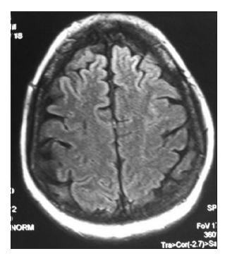 Posterior reversible encephalopathy syndrome due to seronegative systemic lupus erythematosus