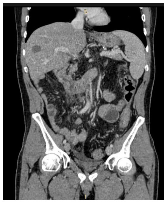 Treatment of liver metastases in patients selected for cytoreductive surgery and hyperthermic intraperitoneal chemotherapy for colorectal peritoneal carcinomatosis