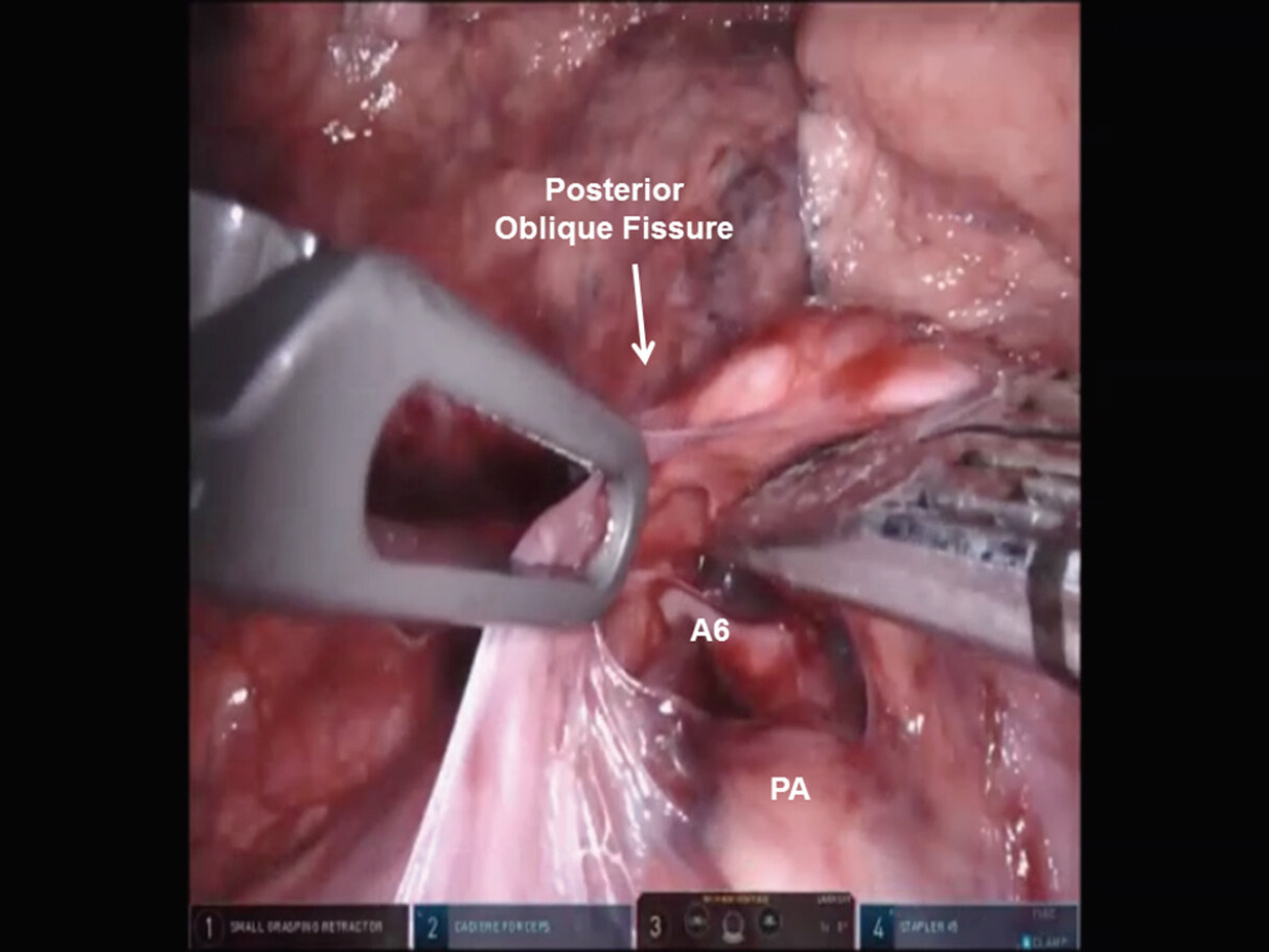 The technique of robotic anatomic pulmonary segmentectomy I: right sided segments