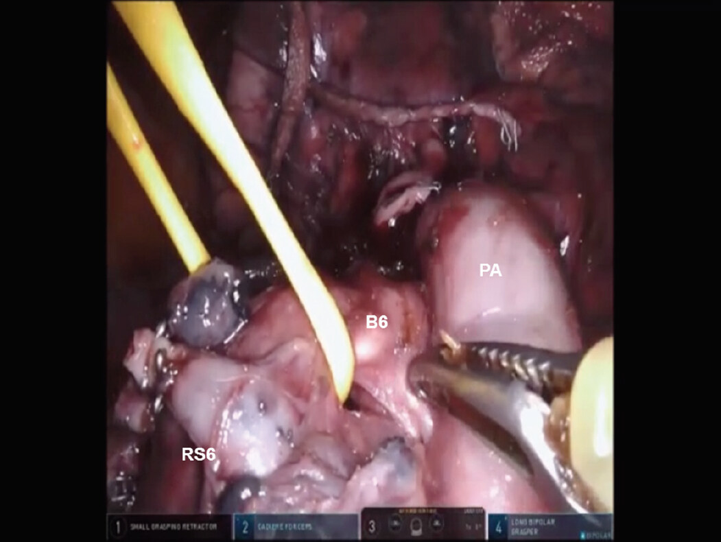 The technique of robotic anatomic pulmonary segmentectomy I: right sided segments