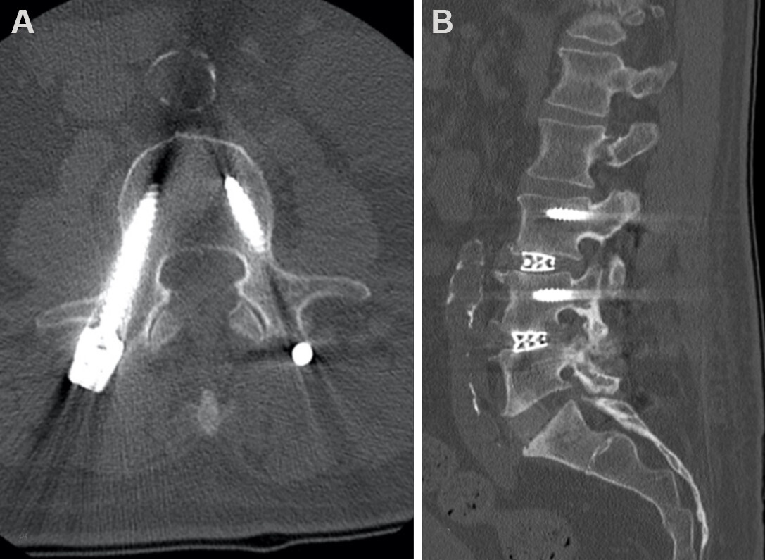 Single position lateral lumbar interbody fusion and pedicle screw fixation: preliminary experience and perioperative results