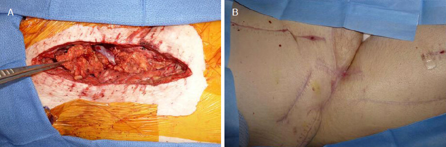 Pedicled omentum for coverage of extra-abdominal vascular bypass graft in the groin