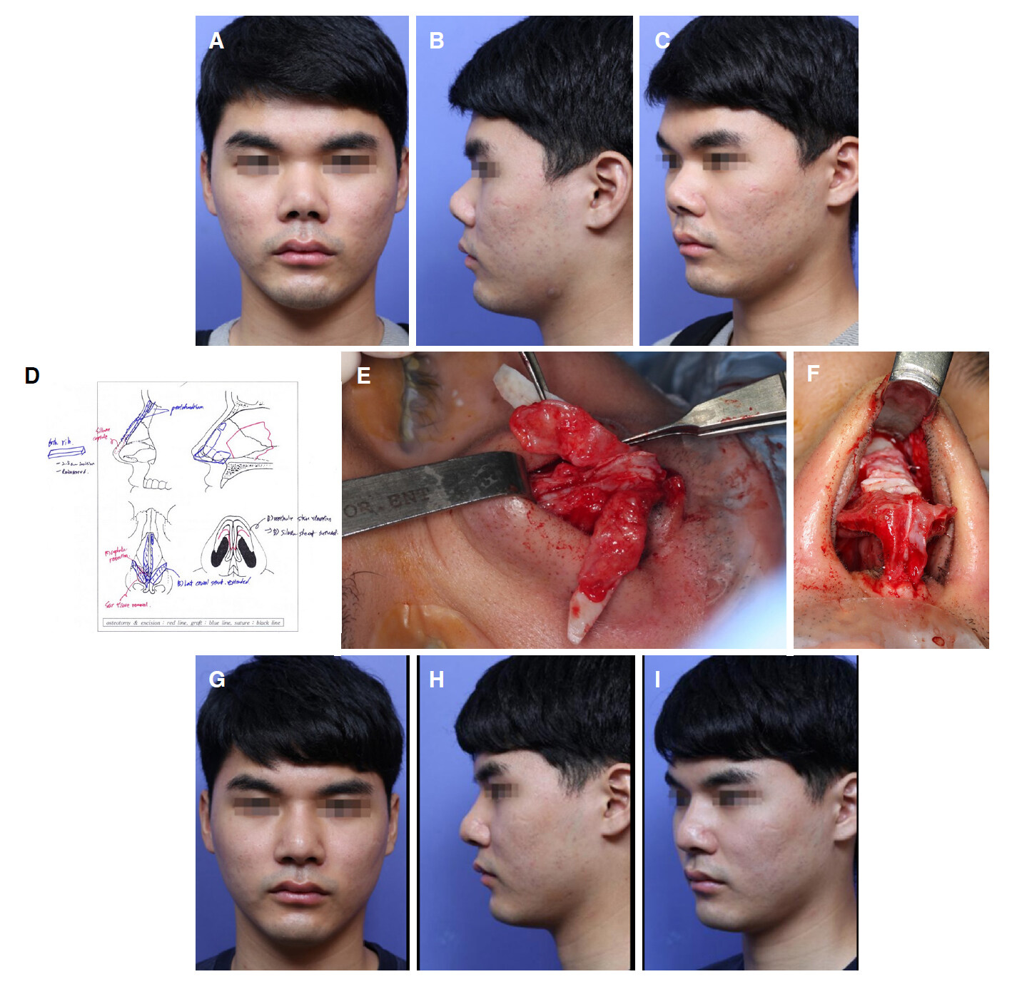 Revision rhinoplasty using autologous rib cartilage in Asians