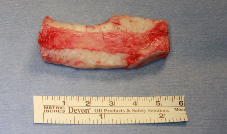 Revision rhinoplasty using autologous rib cartilage in Asians
