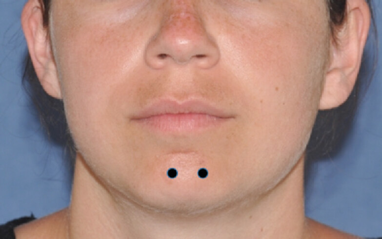 Botulinum toxin in facial plastic surgery