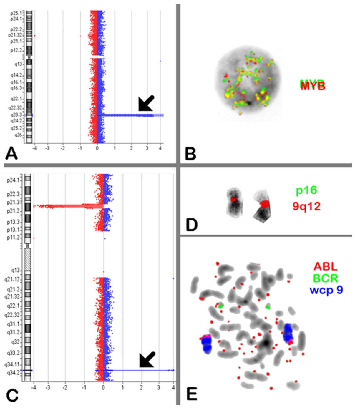 Cryptic <i>NUP214-ABL1</i> fusion with complex karyotype, episomes and intra-tumor genetic heterogeneity in a T-cell lymphoblastic lymphoma