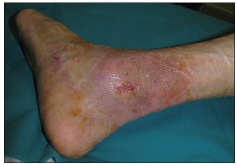 Allogeneic epidermal substitutes in the treatment of chronic diabetic leg and foot ulcers