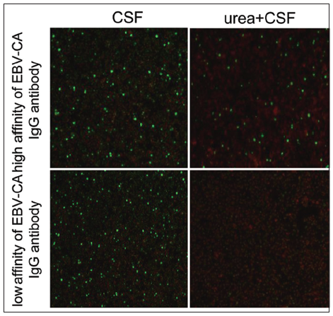 Detection of Epstein-Barr virus infection subtype in patients with multiple sclerosis by indirect immunofluorescence assay