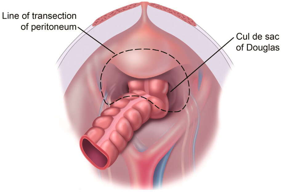 Gastric cancer: prevention and treatment of peritoneal metastases
