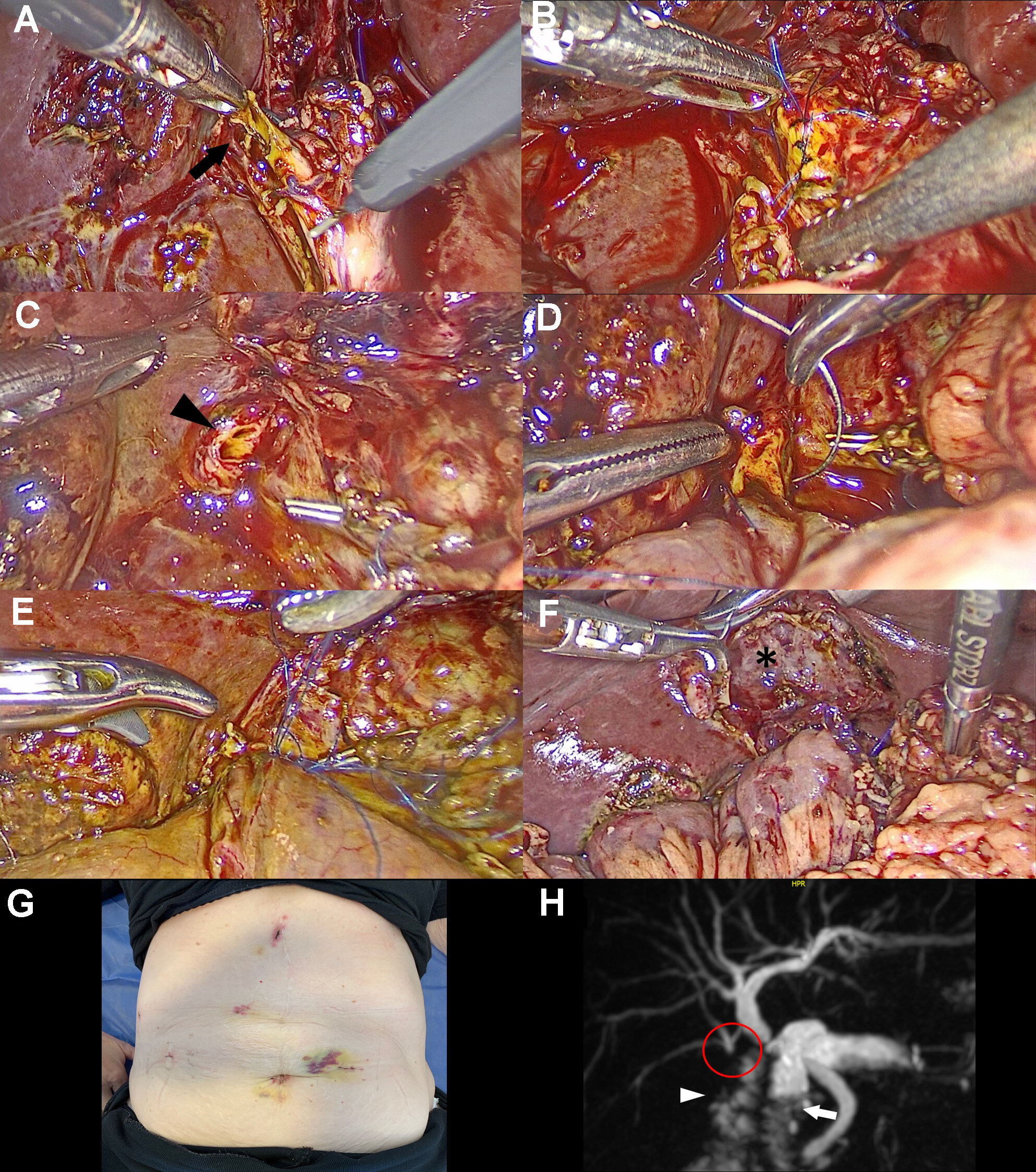 Laparoscopic hepaticojejunostomy for the treatment of bile duct injuries in difficult scenarios (with video)