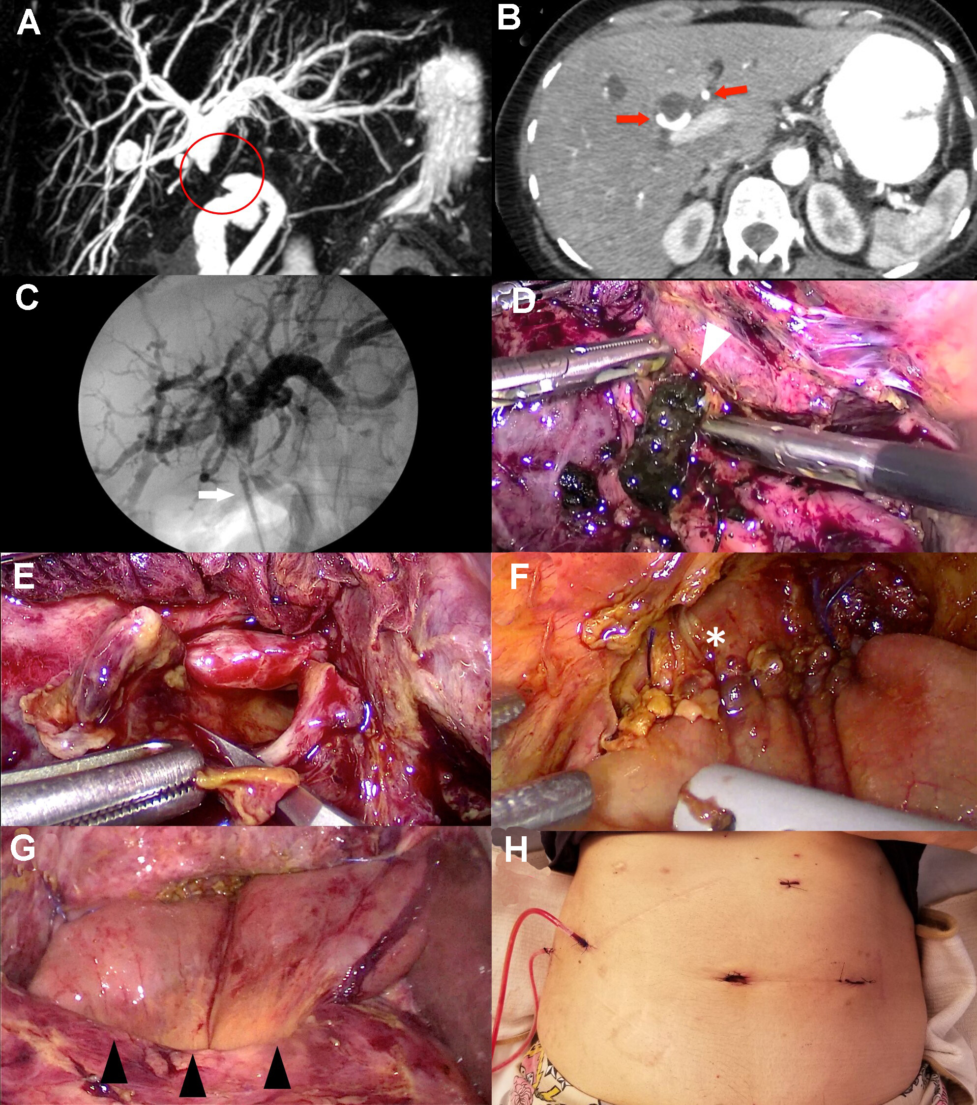 Laparoscopic hepaticojejunostomy for the treatment of bile duct injuries in difficult scenarios (with video)