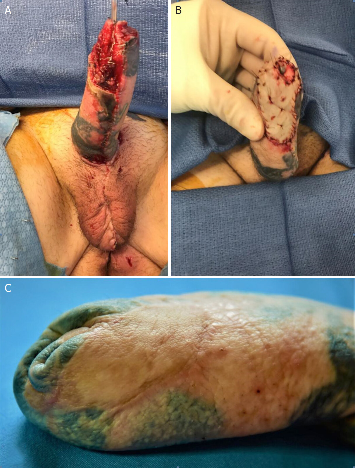 Partial flap loss in transgender phalloplasty using the anterolateral thigh or forearm - a systematic literature review