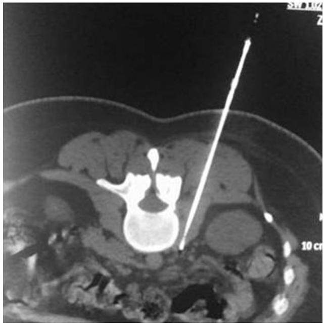 Percutaneous, computed tomography guided neurolysis using continuous radiofrequency for pain reduction in oncologic patients