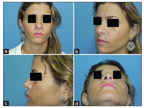 Preliminary stages before nasal reconstruction using forehead flap: restoring perinasal subunits and nostril patency