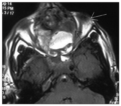 Aneurysmal bone cyst of the maxilla rare presentation with radiological and pathological correlation
