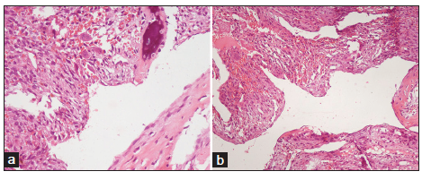 Aneurysmal bone cyst of the maxilla rare presentation with radiological and pathological correlation