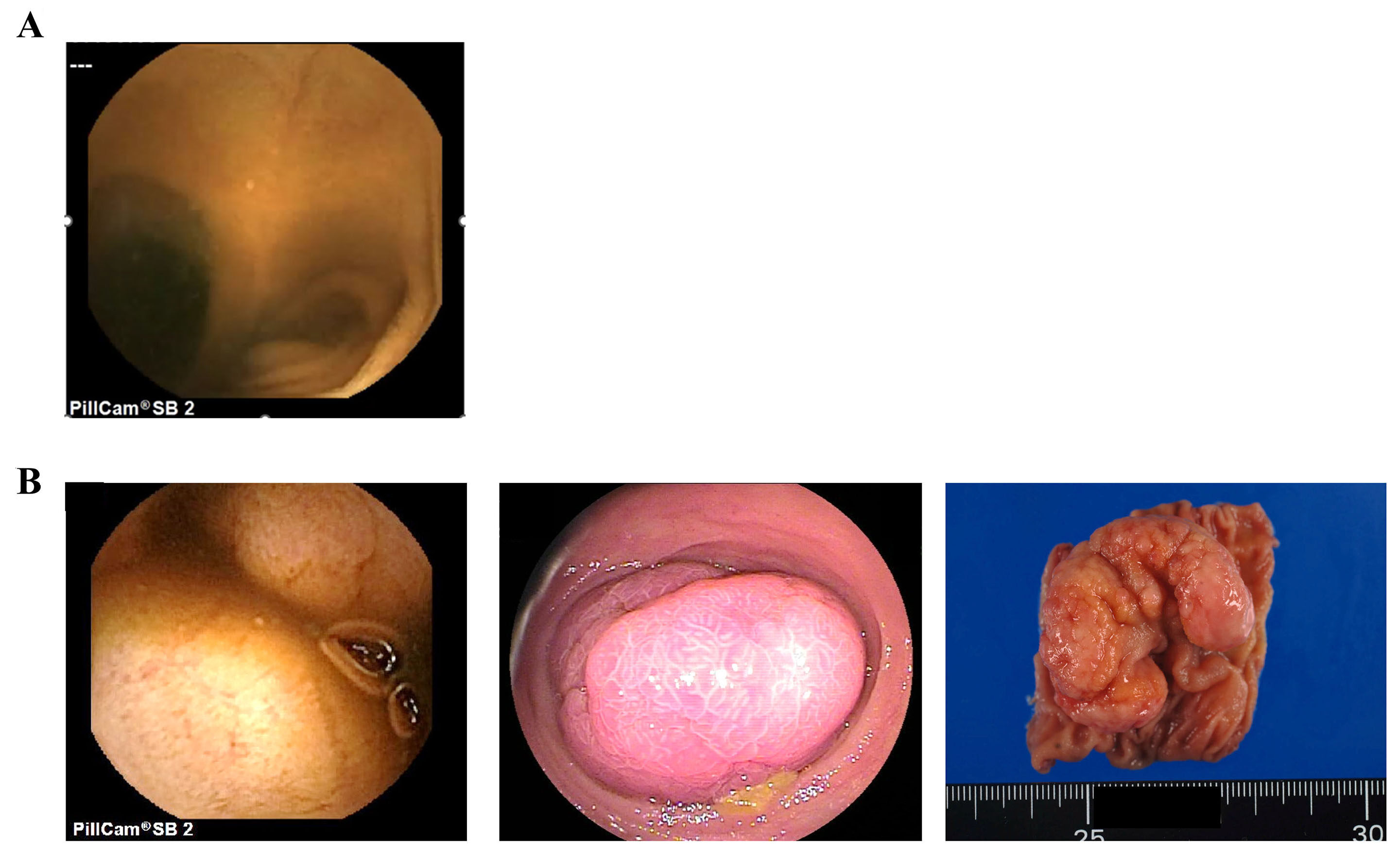 Usefulness of capsule endoscopy for small intestinal obstruction: a dual-center prospective observational study