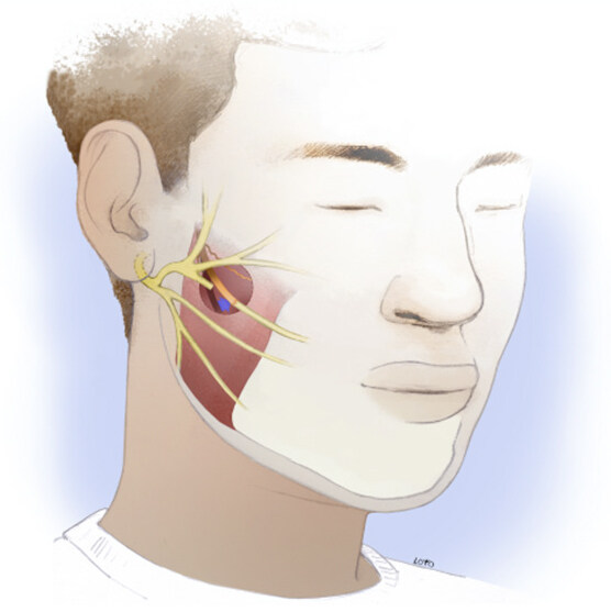Contemporary techniques for nerve transfer in facial reanimation