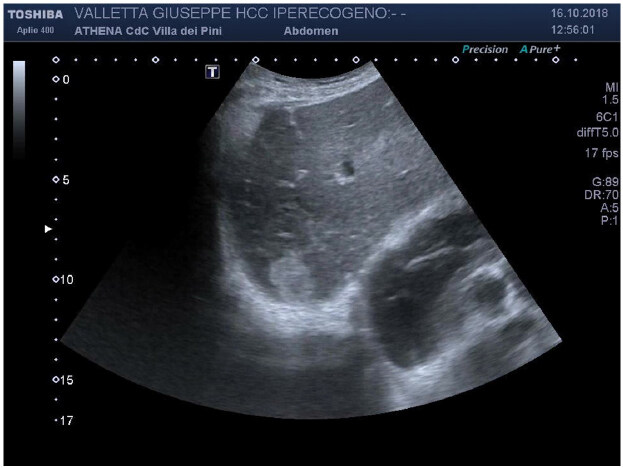 Contrast-enhanced ultrasound with sulphur-hexafluoride in diagnosis of early HCC in cirrhosis