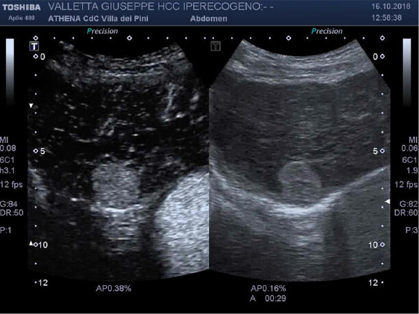 Contrast-enhanced ultrasound with sulphur-hexafluoride in diagnosis of early HCC in cirrhosis