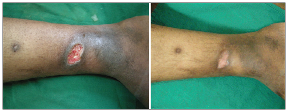 Efficacy of autologous platelet-rich plasma in the treatment of chronic nonhealing leg ulcers
