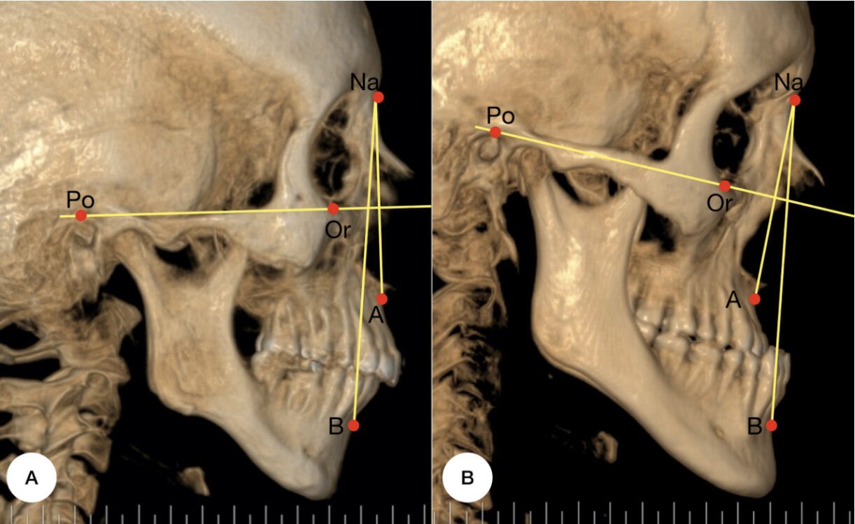 Impact of facial bone deformity on nasal shape